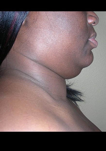 Chin Neck Liposuction Before & After
