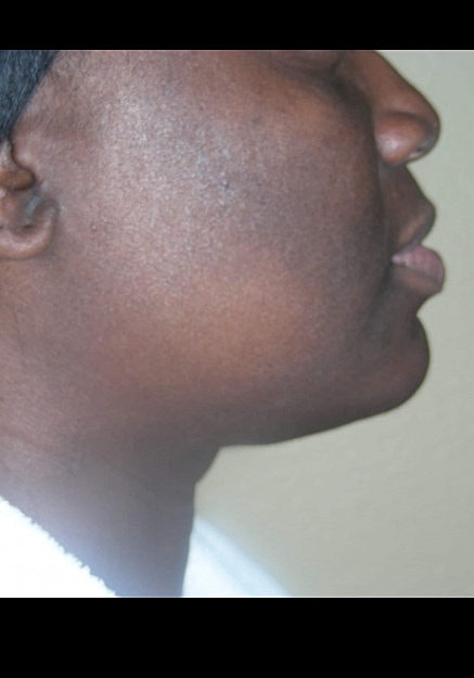 Chin Neck Liposuction Before & After