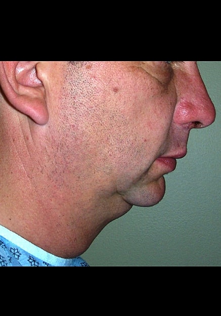 Chin Neck Liposuction Before & After