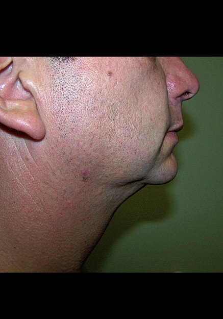 Chin Neck Liposuction Before & After