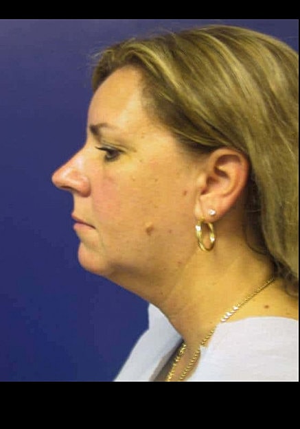 Chin Neck Liposuction Before & After