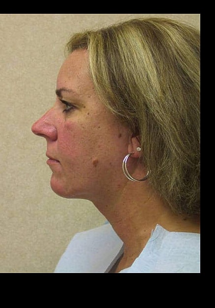 Chin Neck Liposuction Before & After