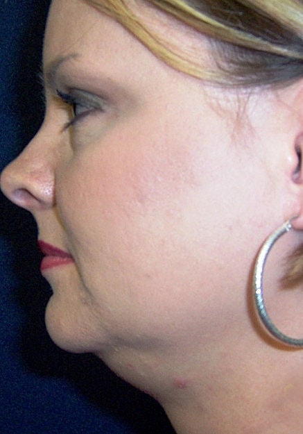 Chin Neck Liposuction Before & After