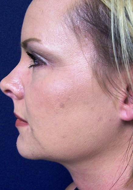 Chin Neck Liposuction Before & After