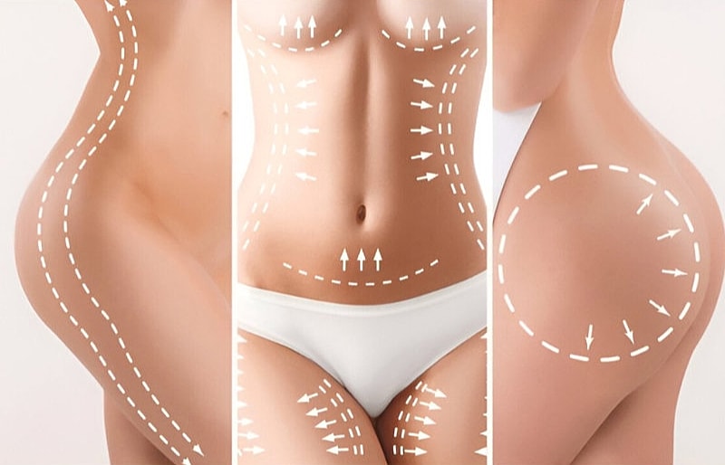 Body Surgery_ Tummy Tuck, Upper Arm Lift, Brazilian Butt Lift, Mommy Makeover, Liposuction