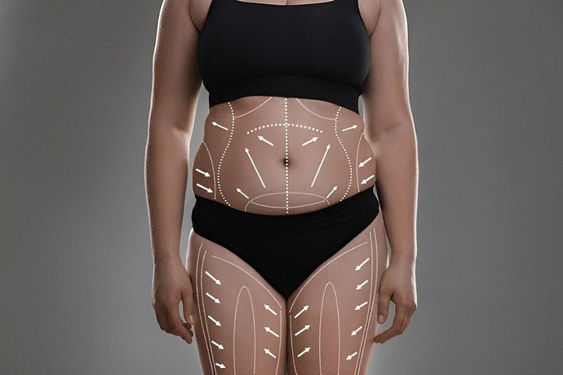 Smart Lipo in Tampa FL
