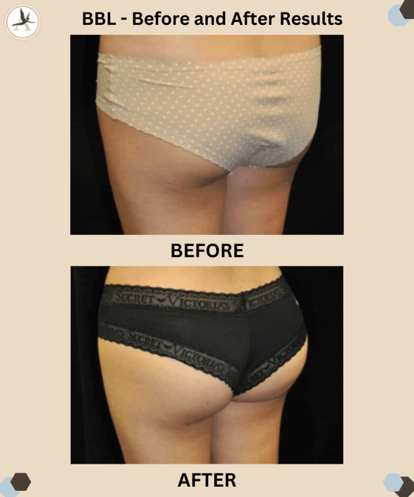 BBL - Before and After Results_Pull Short Shorts Ladies - BBL and Cellfina Butt Treatments Tampa