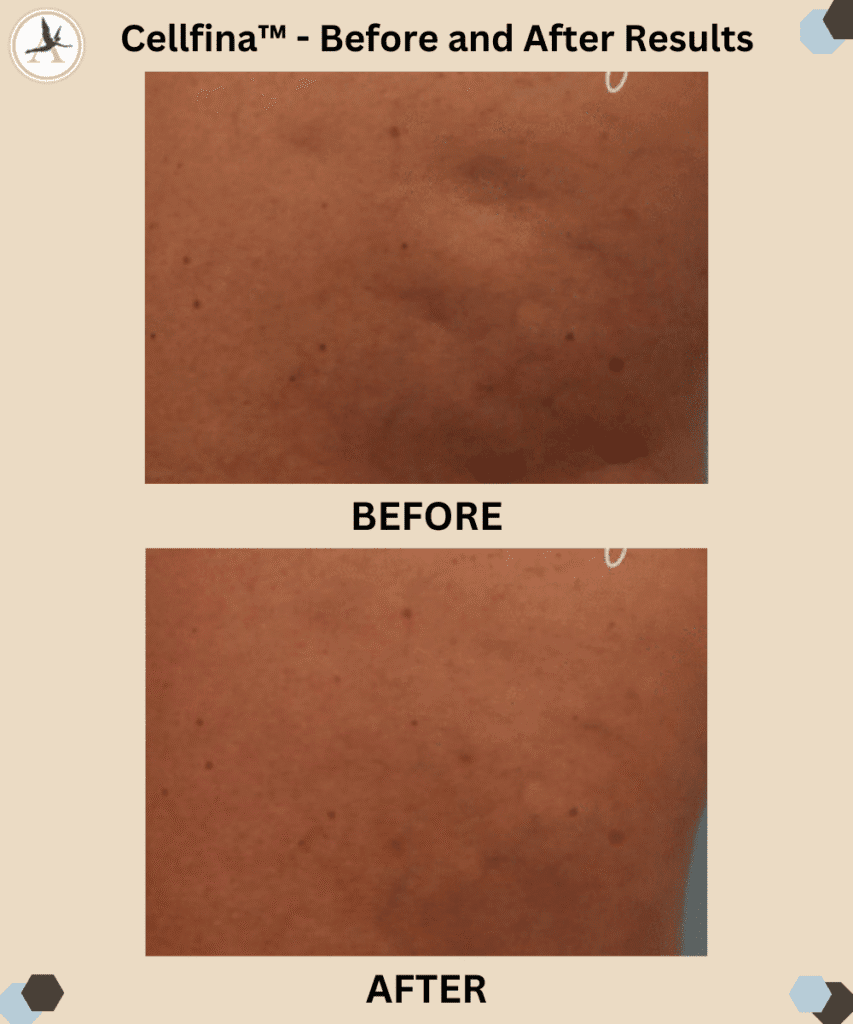 Cellfina™ - Before and After Results_Pull Short Shorts Ladies - BBL and Cellfina Butt Treatments Tampa