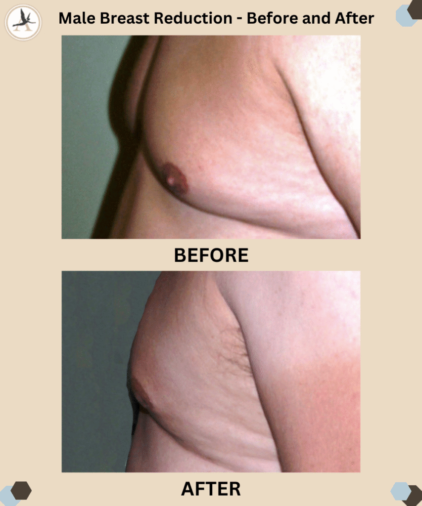Gynecomastia Surgery_Male Breast Reduction Misconceptions - Achieve Masculine Chest_Before After Results Tampa, Bay, Florida