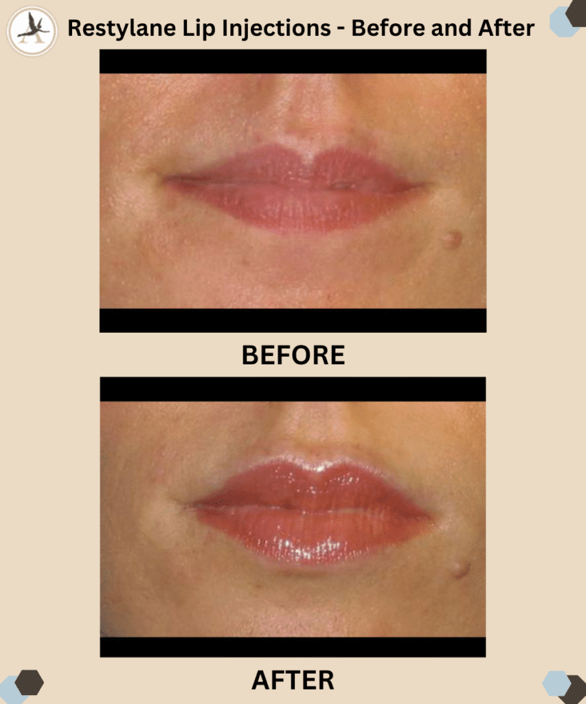 Restylane Lip Injections - Before and After Results Tampa, Florida_Plump Up Your Thin Lips - Minimally Invasive Restylane Silk