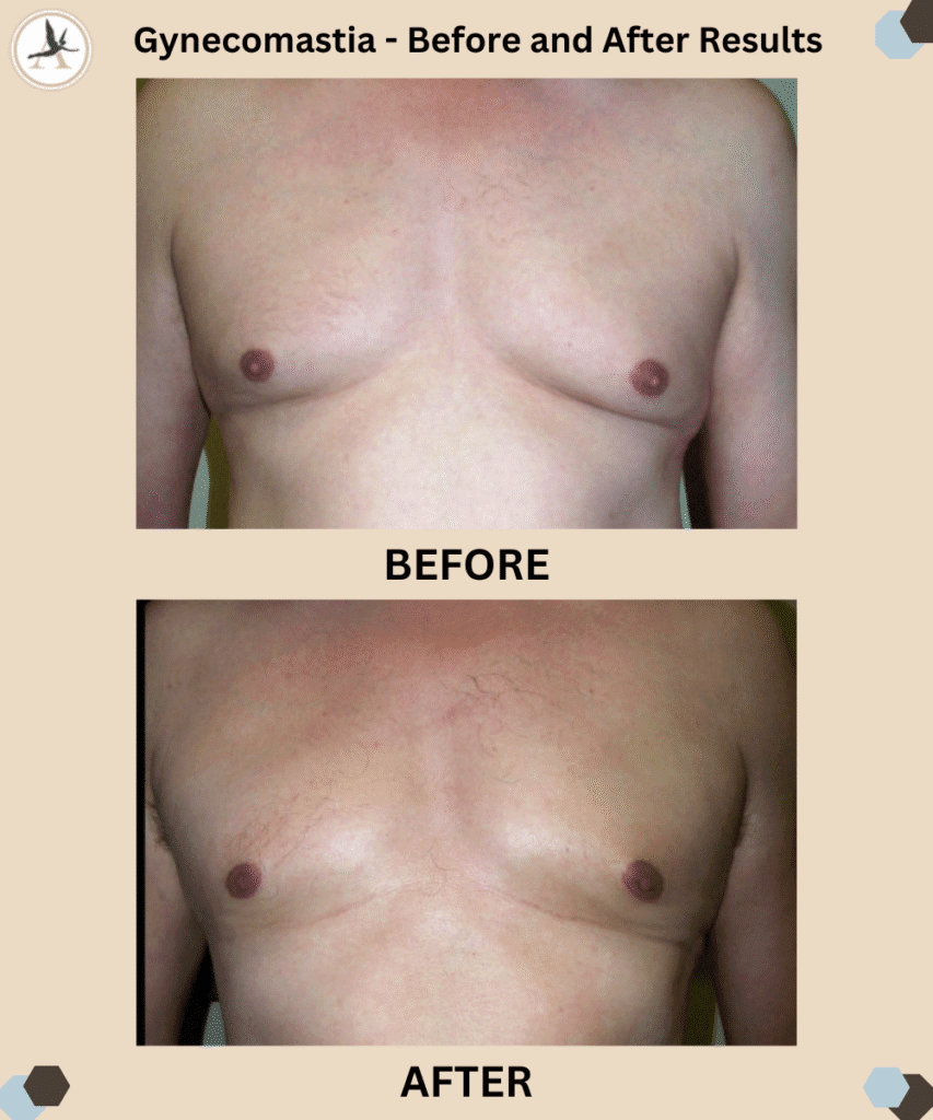 Mens Health Month - Gynecomastia Causes and Treatments_Before and After Results in Tampa, Florida