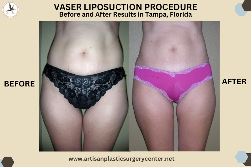 VASER LIPOSUCTION PROCEDURE Before and After Results in Tampa, Florida_Questions You Might Have After Liposuction - Long Lasting Results