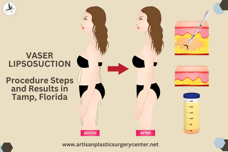 VASER LIPSOSUCTION Procedure Steps and Results in Tampa, Florida