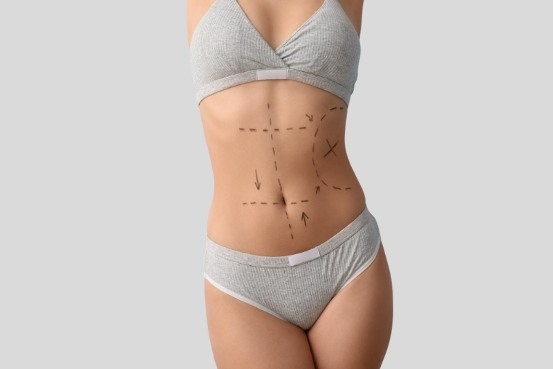 Where Can Liposuction Be Performed - Arms, Back, Neck Buttocks