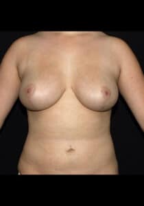 After Image: Breast Lift – Case 18