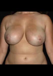 Before Image: Breast Lift – Case 18