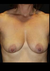 Before Image: Breast Lift/Implants – Case 25