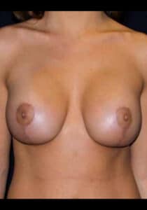 After Image: Breast Lift/Implants Case 26