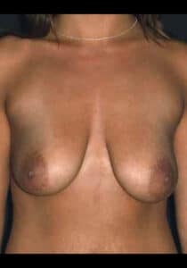 Before Image: Breast Lift/Implants Case 26