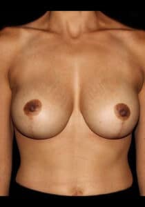 After Image: Breast Lift/Implants – Case 30