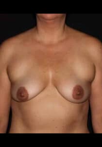 Before Image: Breast Lift/Implants – Case 31