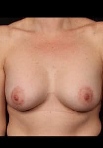 After Image: Breast Lift/Implants – Case 32