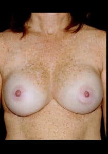 After Image: Breast Implant Revision – Case 6