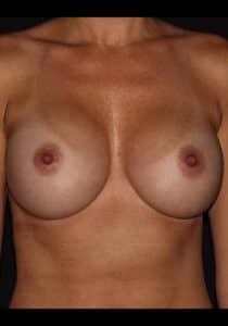 After Image: Breast Implant Revision – Case 10