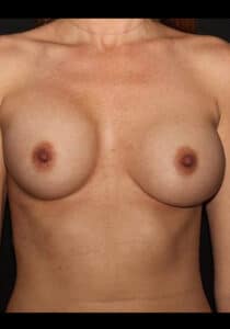 Before Image: Breast Implant Revision – Case 10