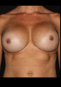 After Image: Breast Implant Revision – Case 11