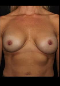 Before Image: Breast Implant Revision – Case 11