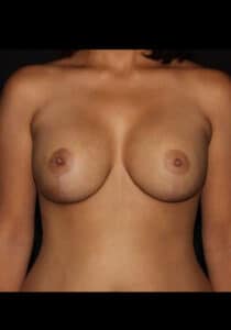 After Image: Breast Implant Revision – Case 13