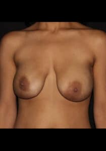 Before Image: Breast Implant Revision – Case 13