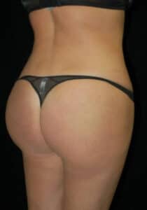 After Image: Brazilian Butt Lift – Case 18