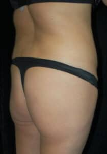 Before Image: Brazilian Butt Lift – Case 18