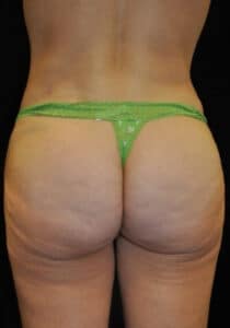 After Image: Brazilian Butt Lift – Case 20