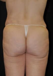 Before Image: Brazilian Butt Lift – Case 20