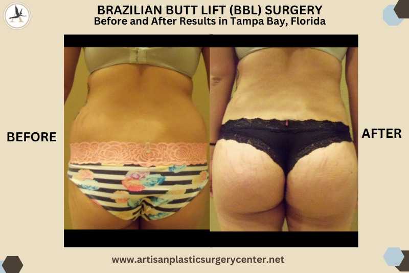 Brazilian Butt Lift (BBL) Surgery Before and After Results in Tampa Bay, Florida_Butt Lift Difference - Brazilian Butt Lift vs Traditional Butt Lift