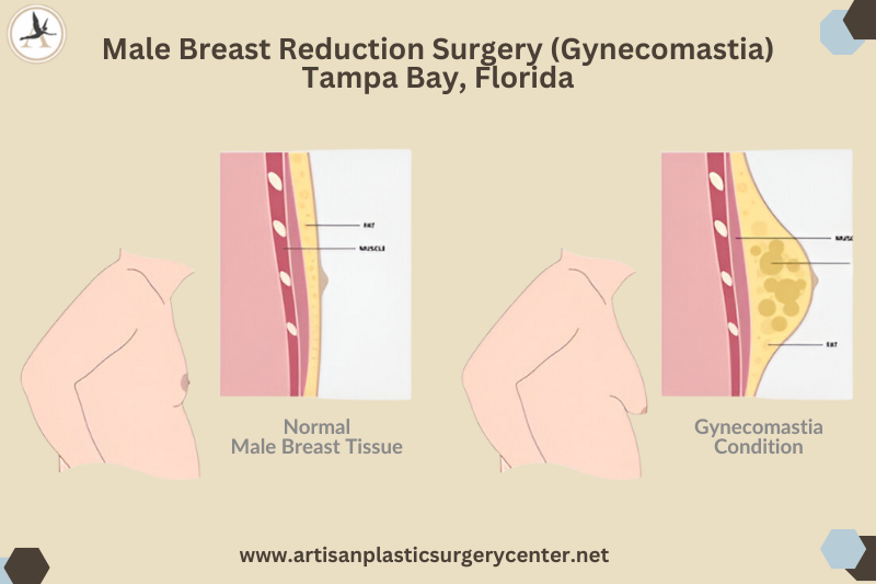 Male Breast Reduction Surgery (Gynecomastia) in Tampa Bay, Florida
