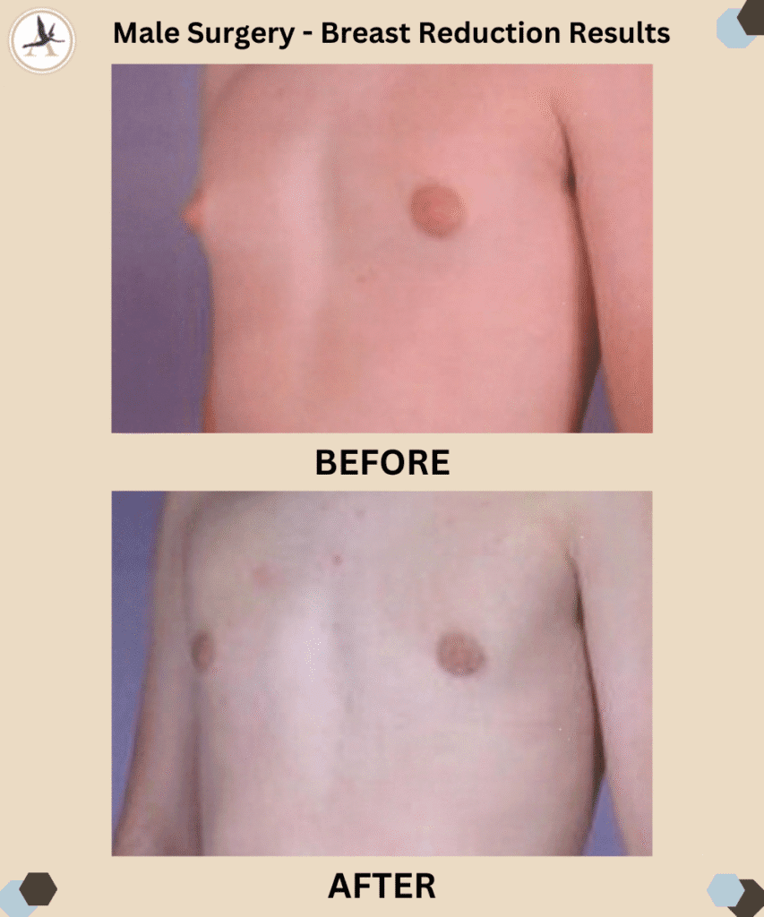 Male Surgery Gynecomastia_Before After Results Tampa, Florida_Are You a Good Candidate for Breast Reduction