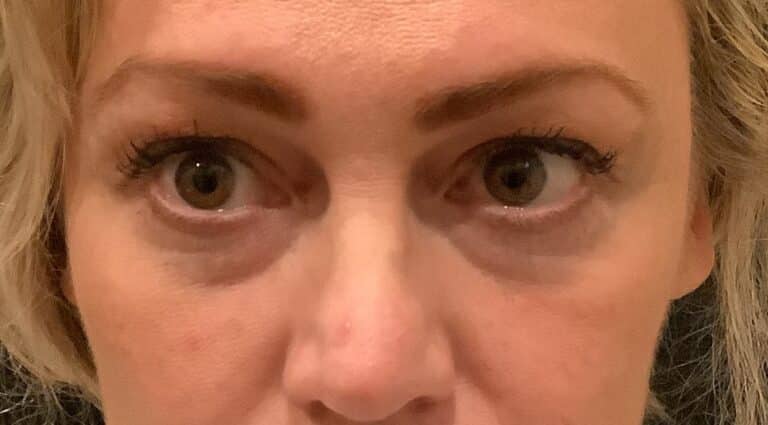 Before Image: Eyelid Surgery – Case 14 - front