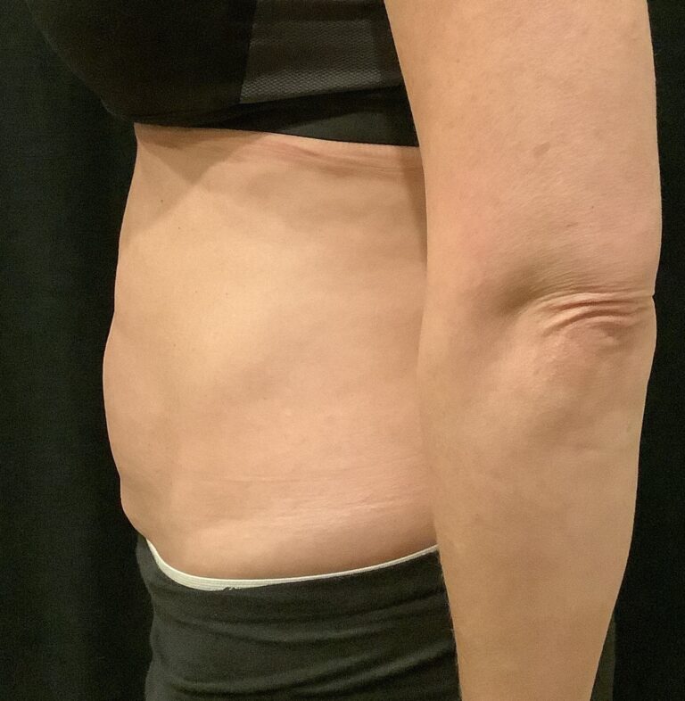 After Image: Vaser Liposuction – Case 31 - left-side