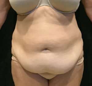 Before Image: Abdominoplasty – Case 19