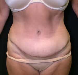 After Image: Abdominoplasty – Case 19