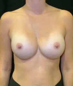 After Image: Breast Augmentation – Case 34