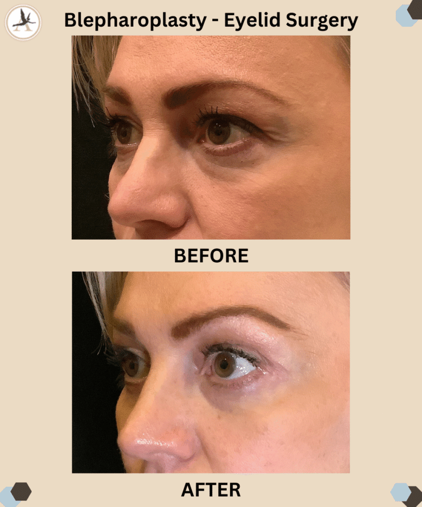 Will People Notice My Blepharoplasty Tampa Insights by Dr. Castor